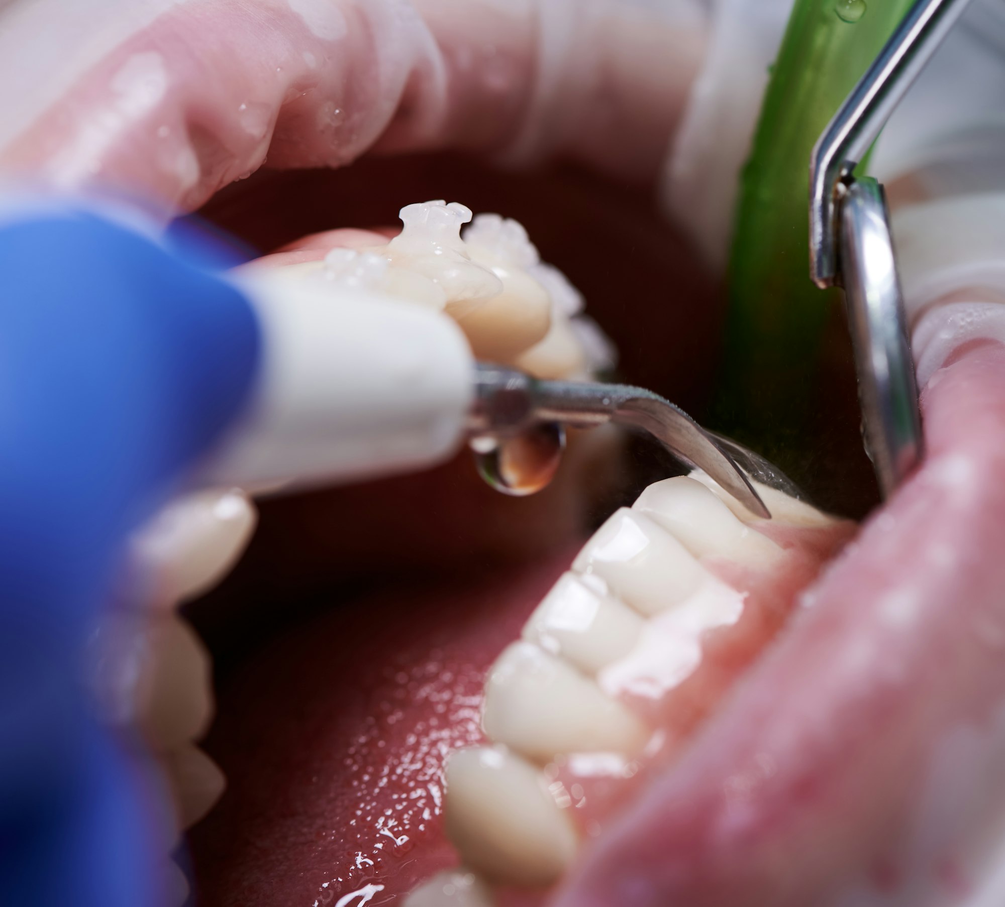 Doctor doing professional teeth cleaning in dental clinic